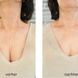 FRAUSCHMITZ Beauty Dekolleté vorher - nachher