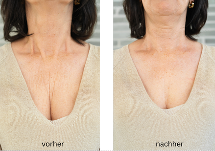 FRAUSCHMITZ Beauty Dekolleté vorher - nachher